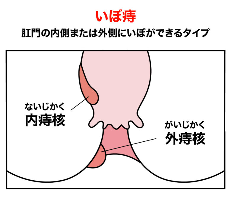 自宅で簡単 痔が改善する運動を紹介 しりたいライフ